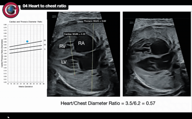 Enhancing fetal cardiac screening in the second and third trimesters